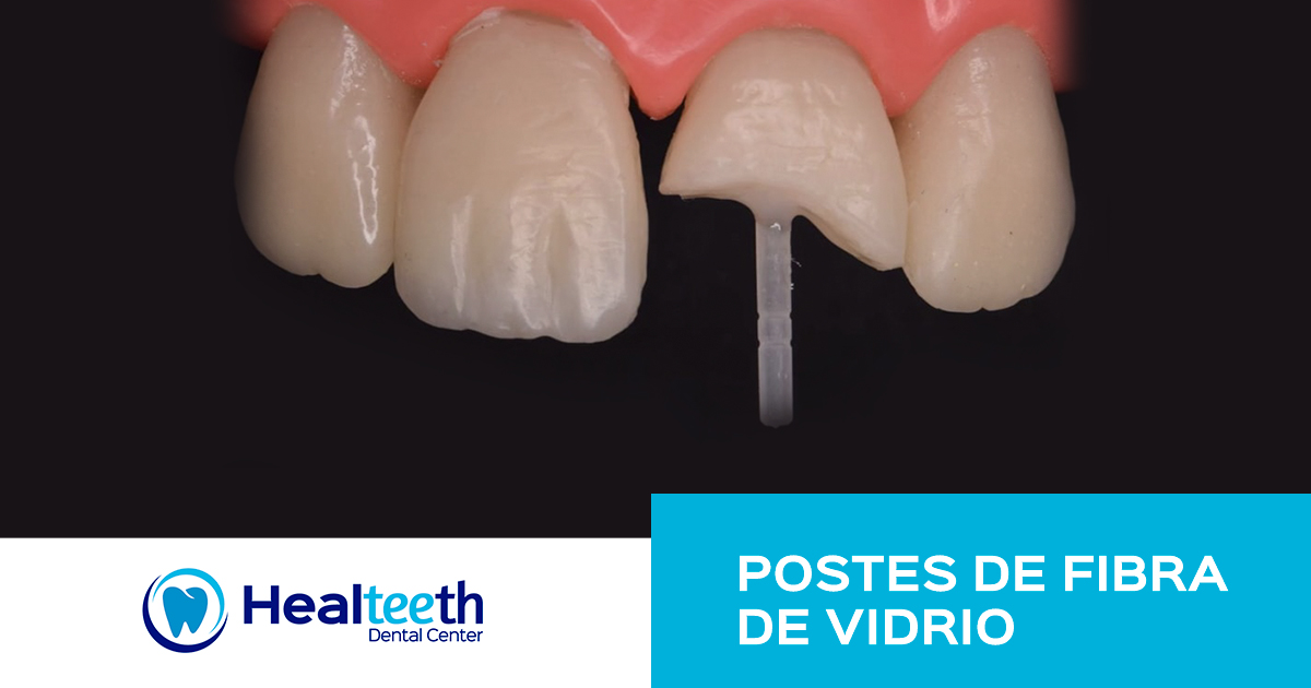 POSTES DE FIBRA DE VIDRIO DENTALES